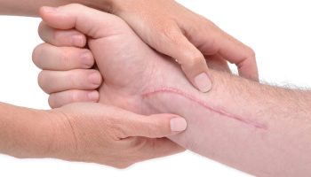 Hands,Massaging,A,Arm,With,Scar